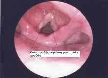 οίδημα του Reinke